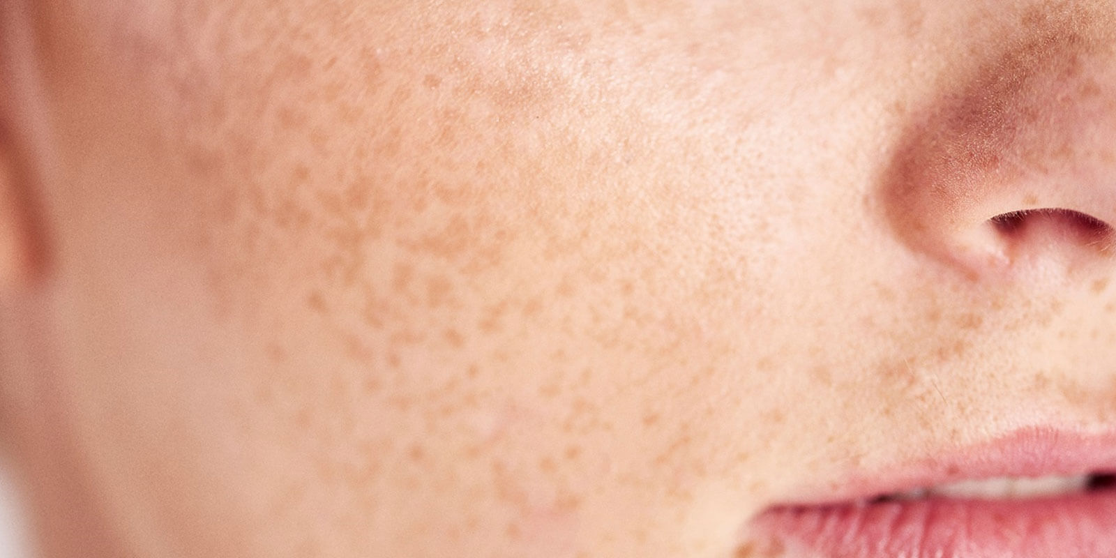 Read more about the article Things You Need To Know About Pigmentation